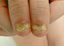 nail  fungus treatment 